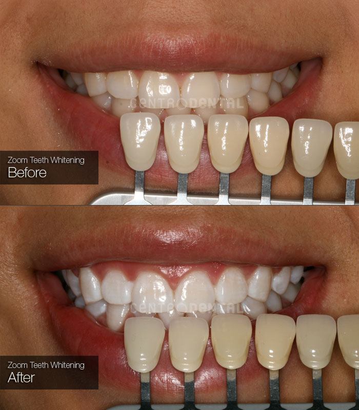 Zoom Teeth Whitening - Centro Dental in Richmond, BC - Since 1978