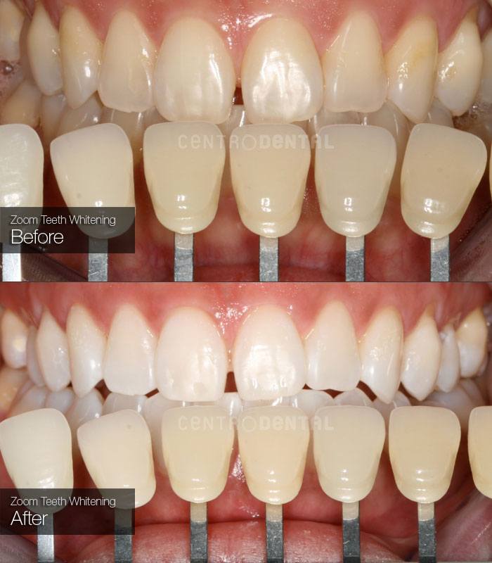 Zoom Teeth Whitening - Centro Dental in Richmond, BC - Since 1978